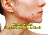 Muhase Ka ilaj Pimples Treatment in Hindi
